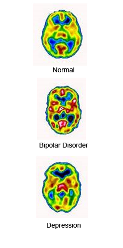 bipolar-brain