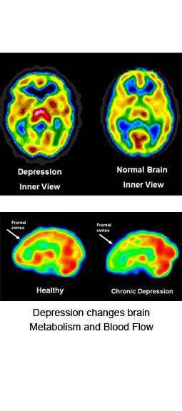 depression-brain